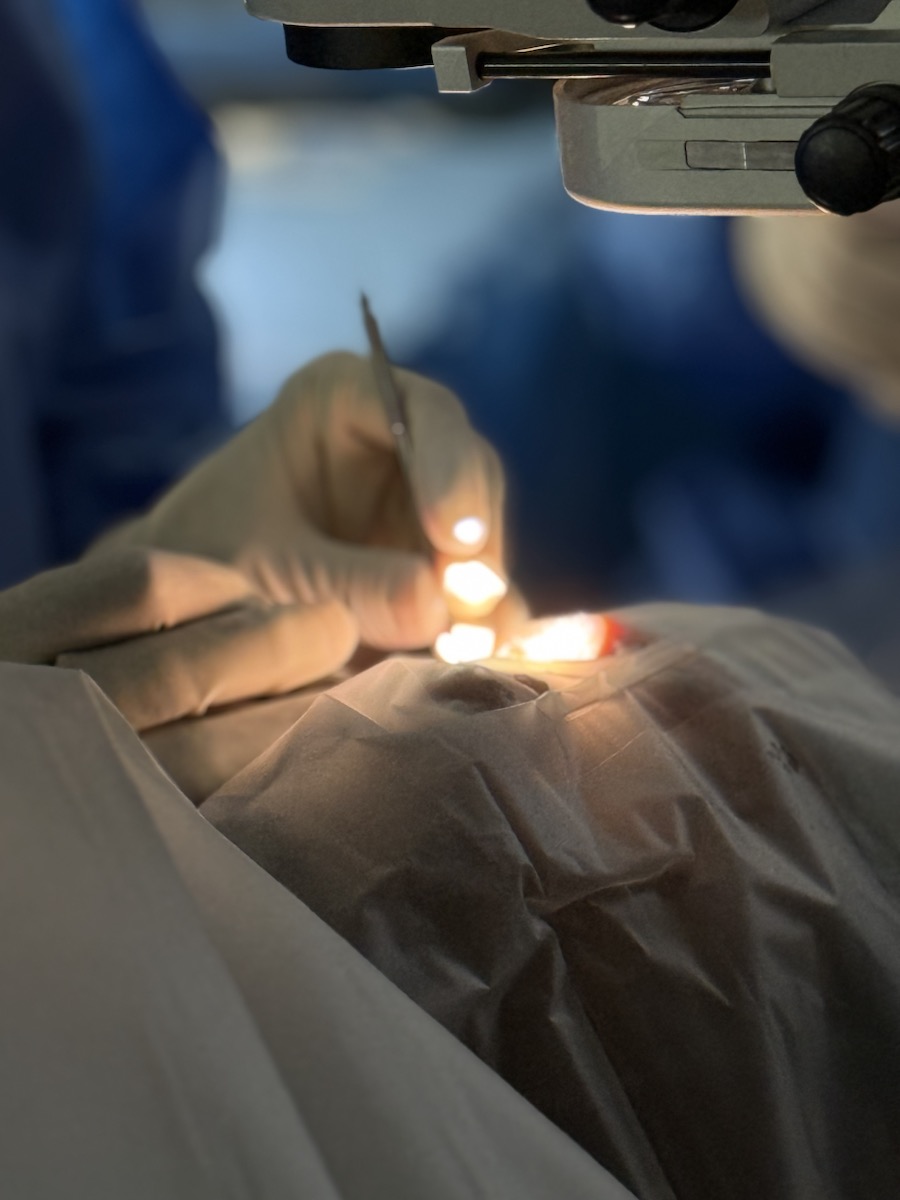 Close-up of ophthalmic surgery